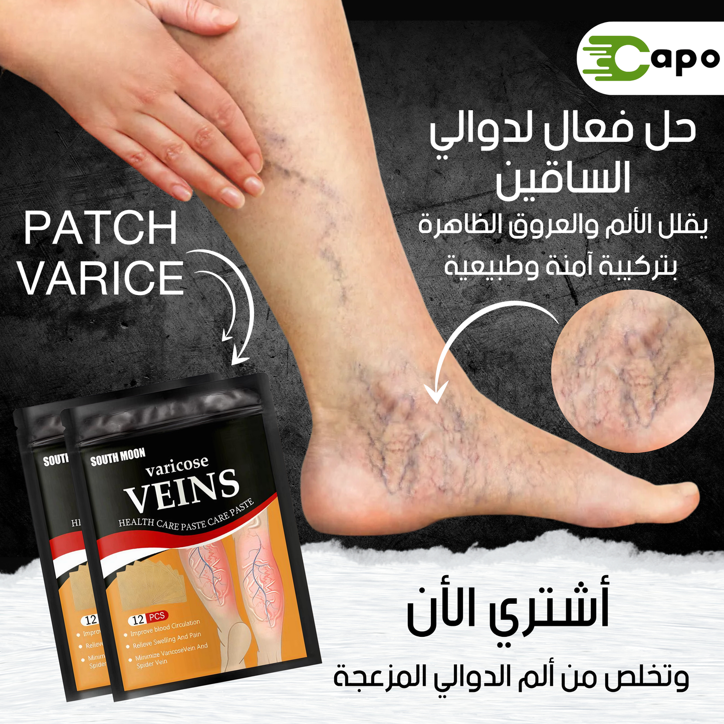 Patch Varices